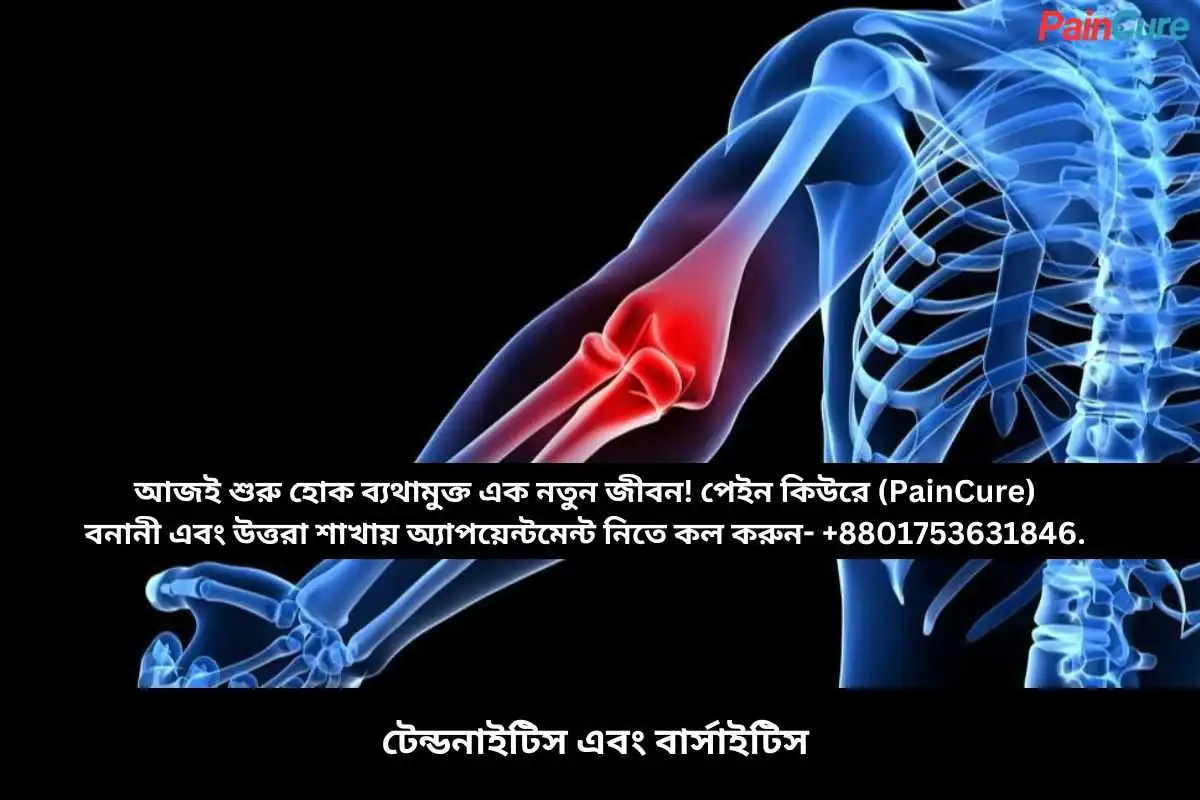 টেন্ডনাইটিস এবং বার্সাইটিস