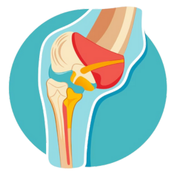আর্থ্রাইটিস