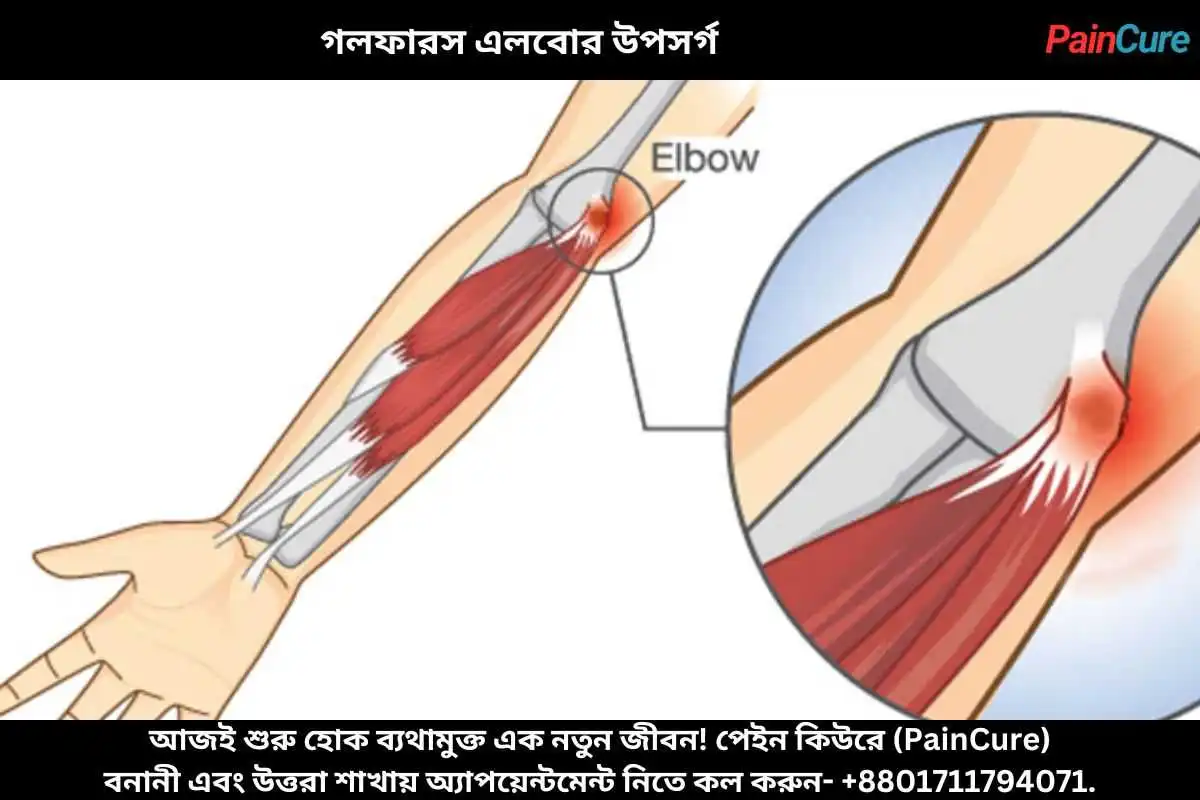 গলফারস এলবোর উপসর্গ
