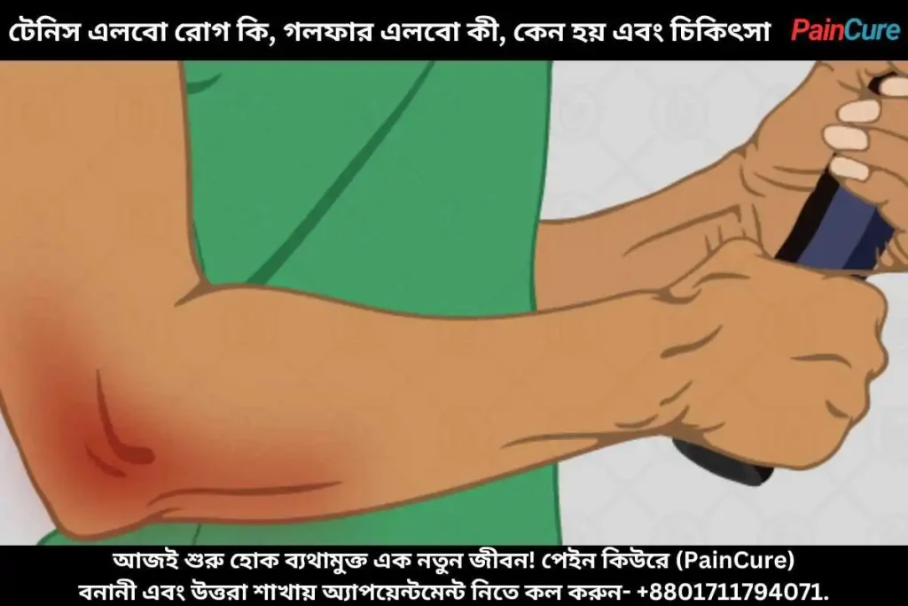 টেনিস এলবো রোগ কি, গলফার এলবো কী, কেন হয় এবং চিকিৎসা