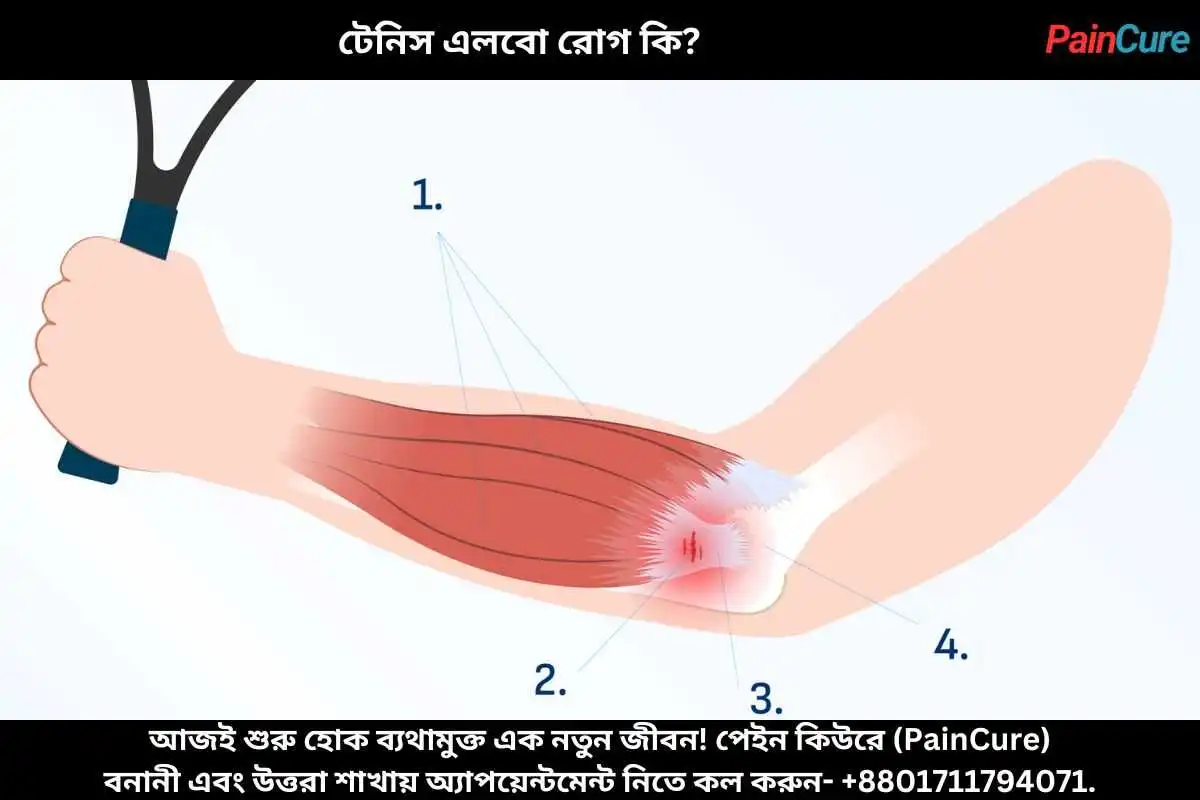 টেনিস এলবো রোগ কি