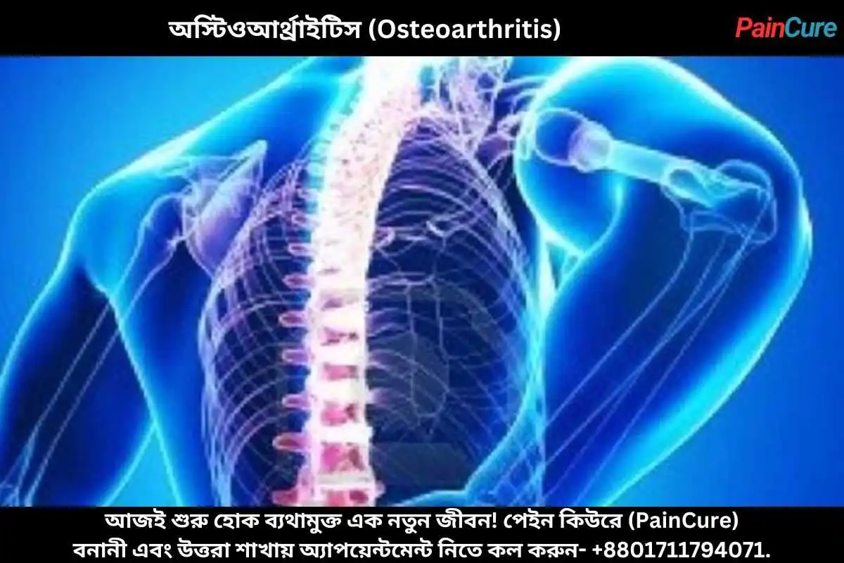 অস্টিওআর্থ্রাইটিস (Osteoarthritis)