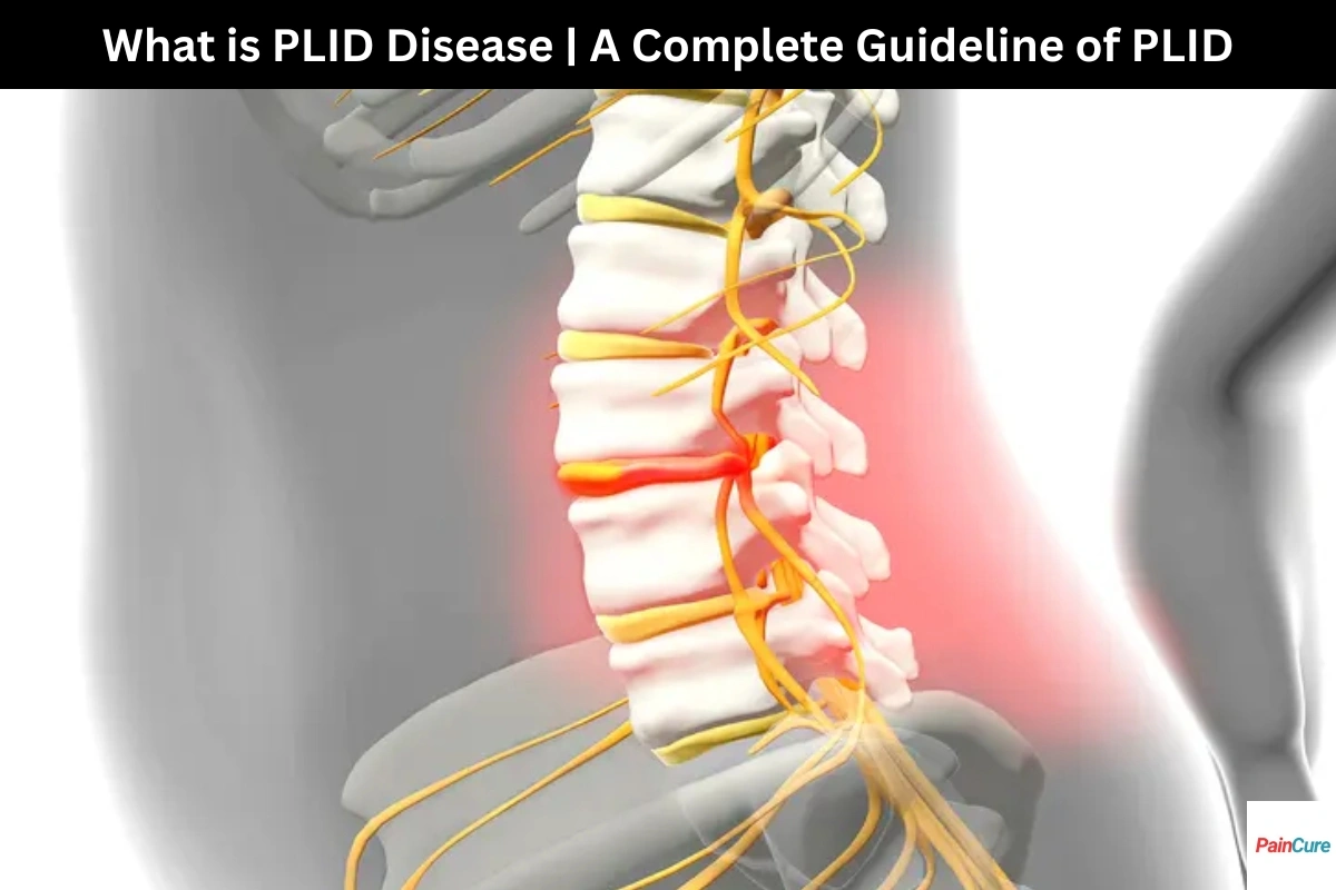 what is PLID Disease A complete Guideline of plid