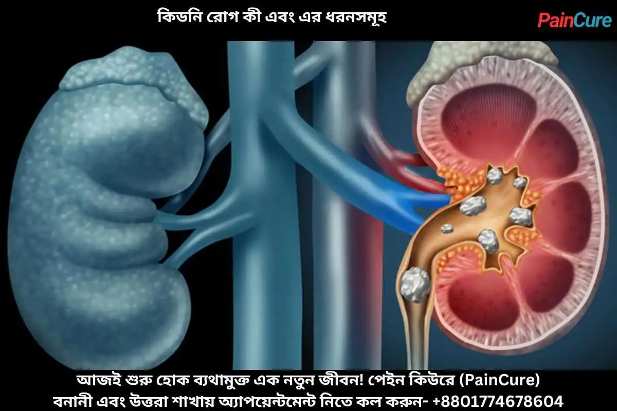 কিডনি রোগ কী এবং এর ধরনসমূহ