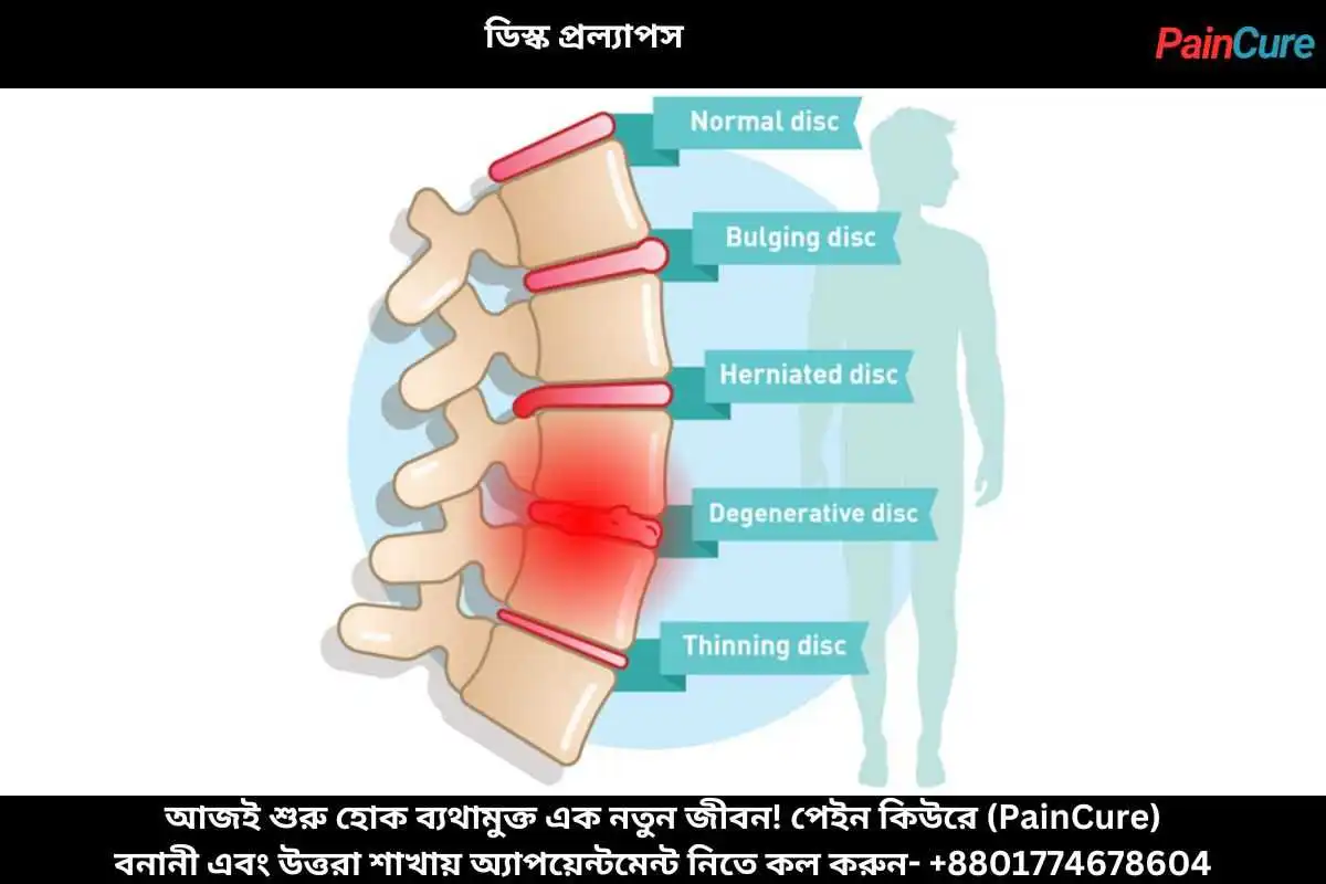 ডিস্ক প্রল্যাপস