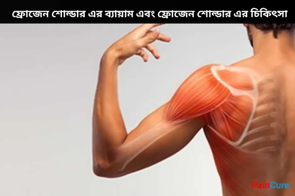 ফ্রোজেন শোল্ডার এর ব্যায়াম এবং ফ্রোজেন শোল্ডার এর চিকিৎসা