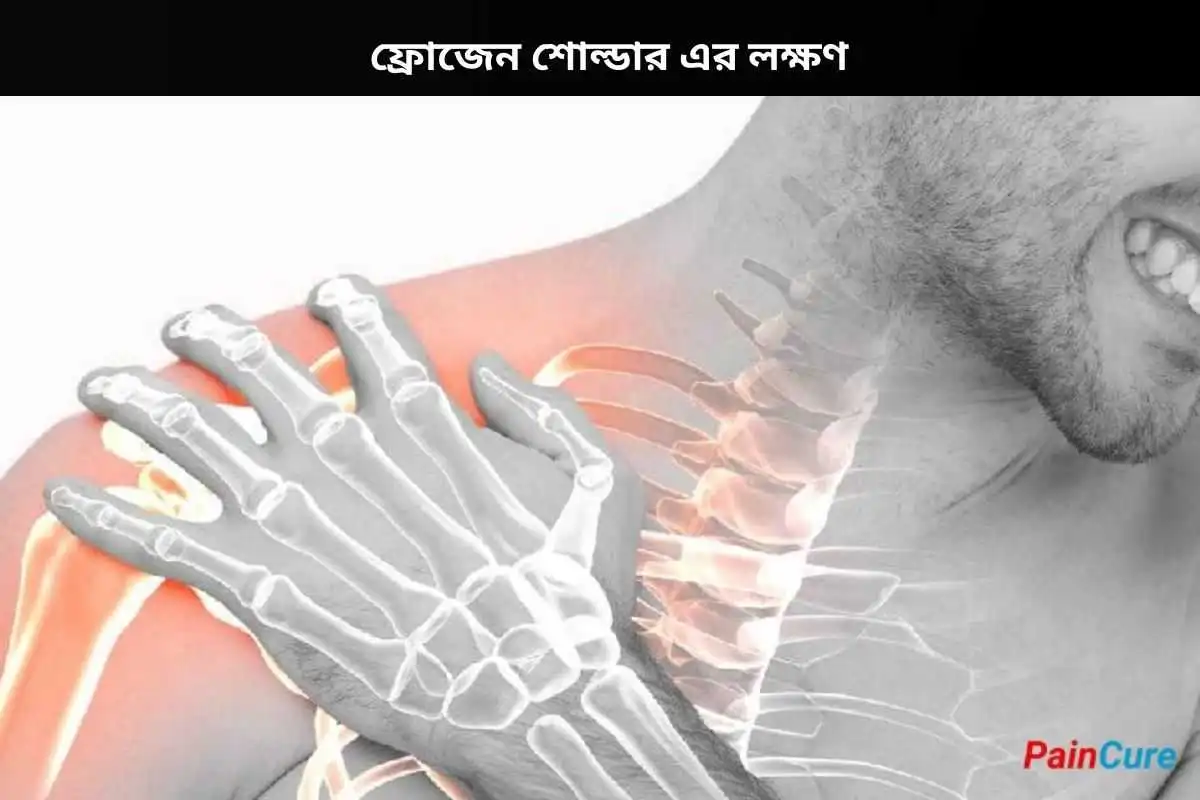 ফ্রোজেন শোল্ডার এর লক্ষণ
