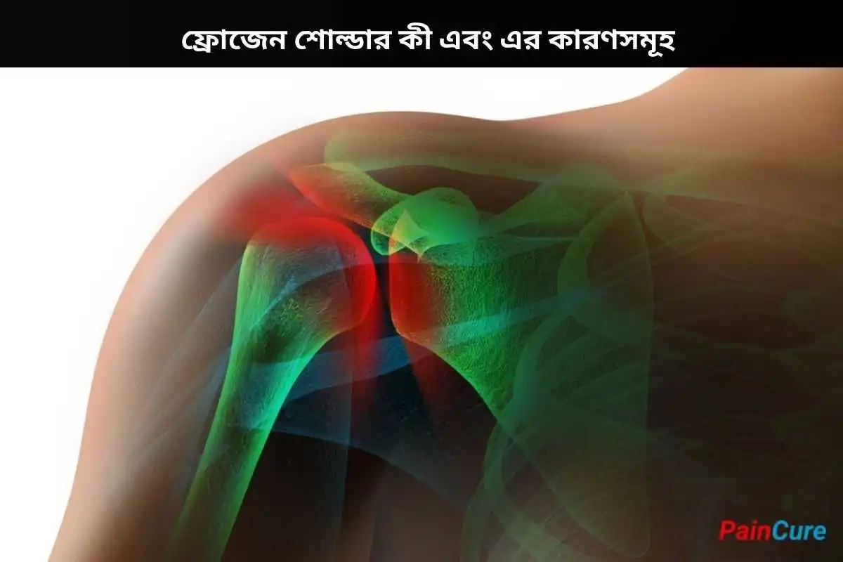 ফ্রোজেন শোল্ডার কী এবং এর কারণসমূহ