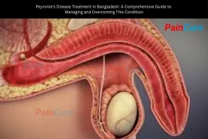 Peyronie's Disease Treatment in Bangladesh: A Comprehensive Guide to Managing and Overcoming This Condition