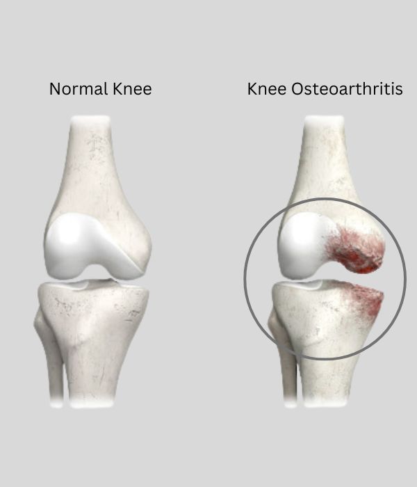 Osteoarthritis