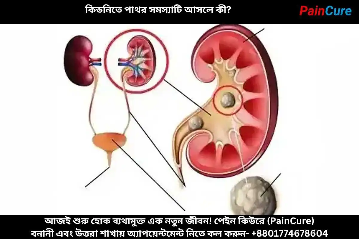 কিডনিতে পাথর সমস্যাটি আসলে কী