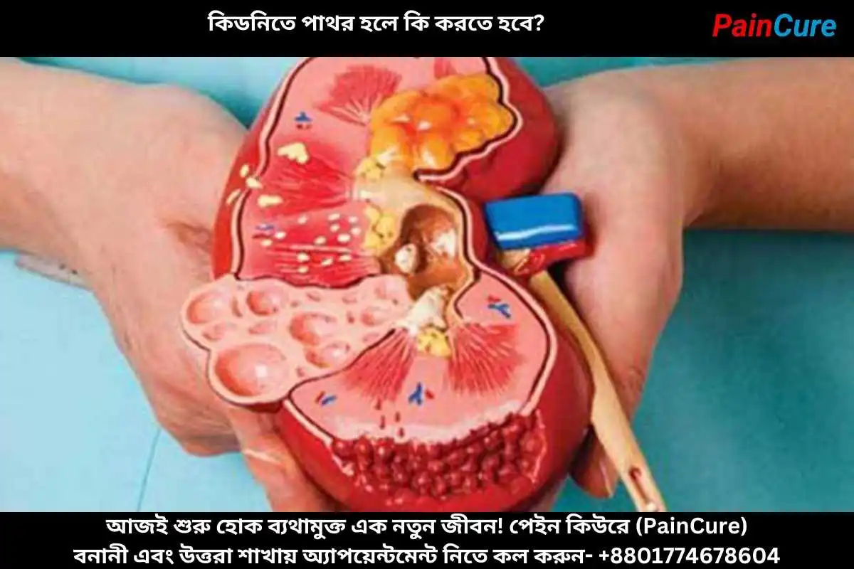 কিডনিতে পাথর হলে কি করতে হবে
