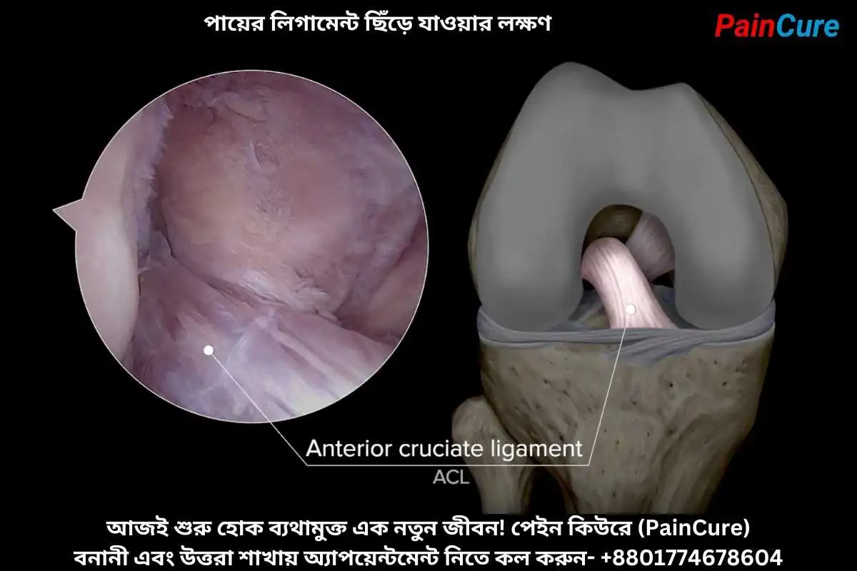 পায়ের লিগামেন্ট ছিঁড়ে যাওয়ার লক্ষণ