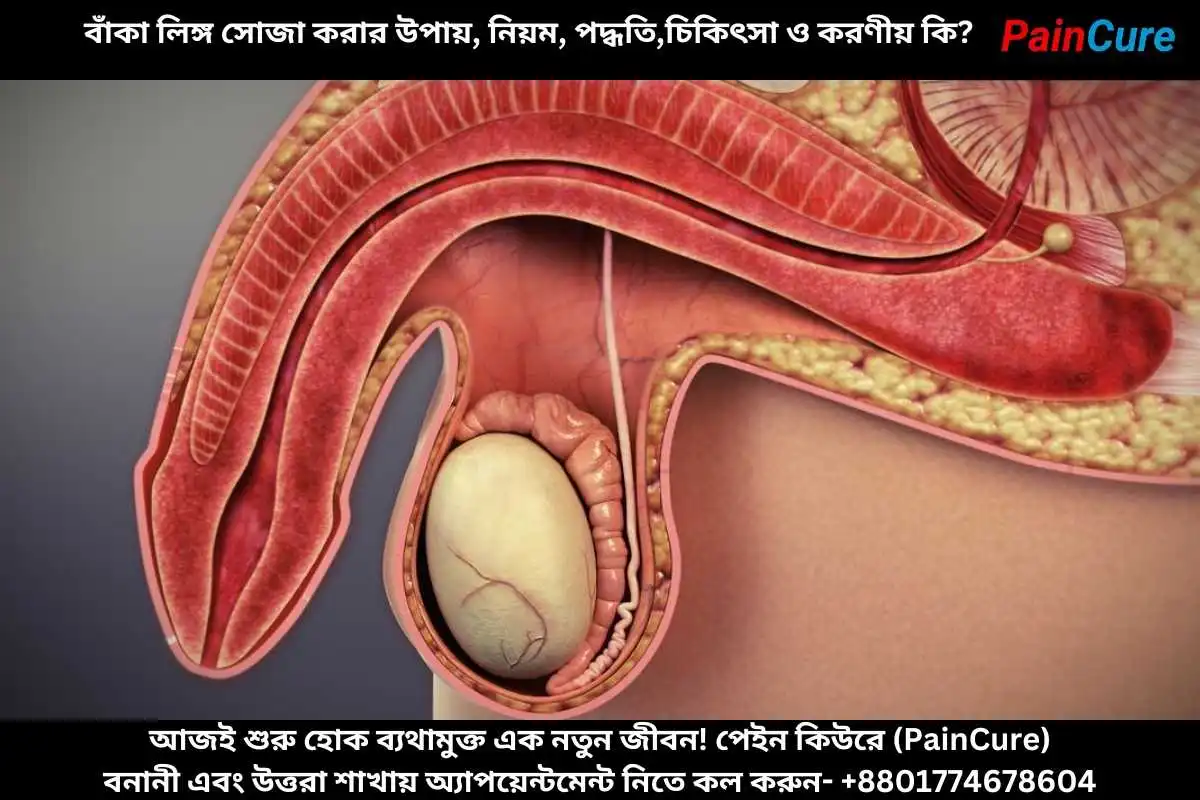বাঁকা লিঙ্গ সোজা করার উপায়,নিয়ম,পদ্ধতি,চিকিৎসা ও করণীয় কি