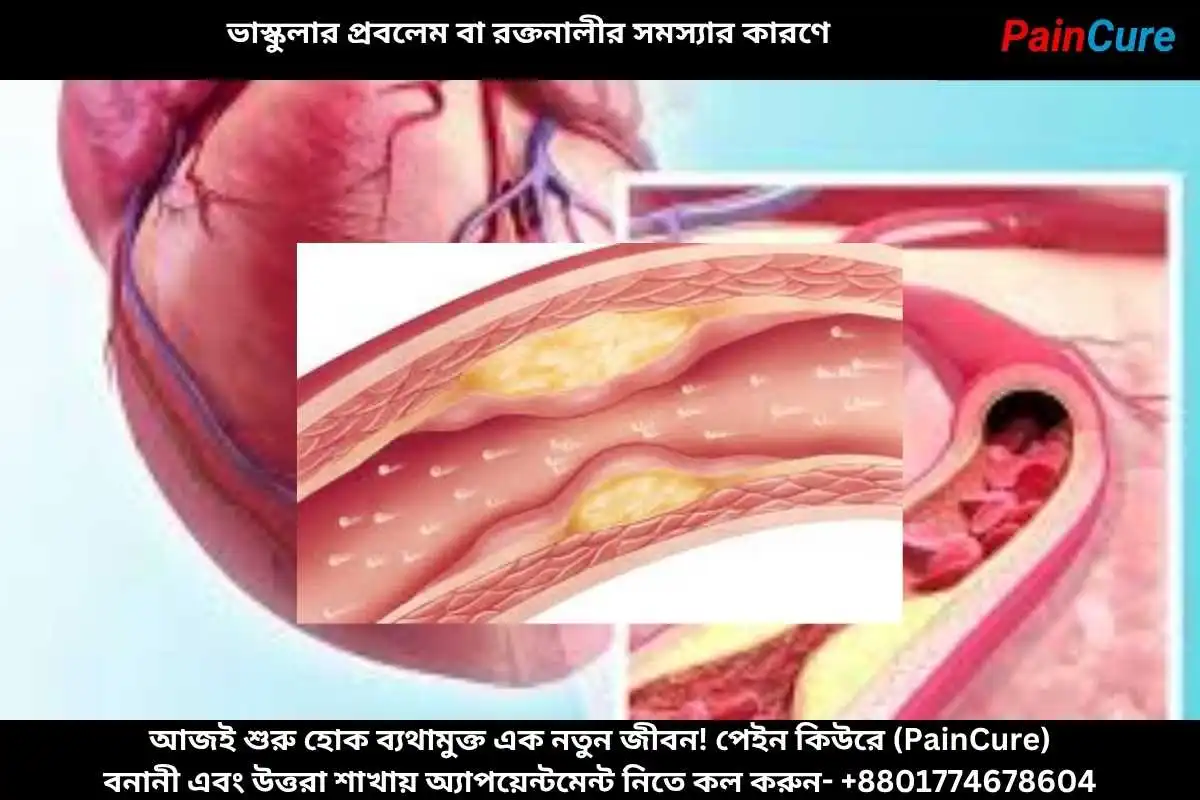 ভাস্কুলার প্রবলেম বা রক্তনালীর সমস্যার কারণে