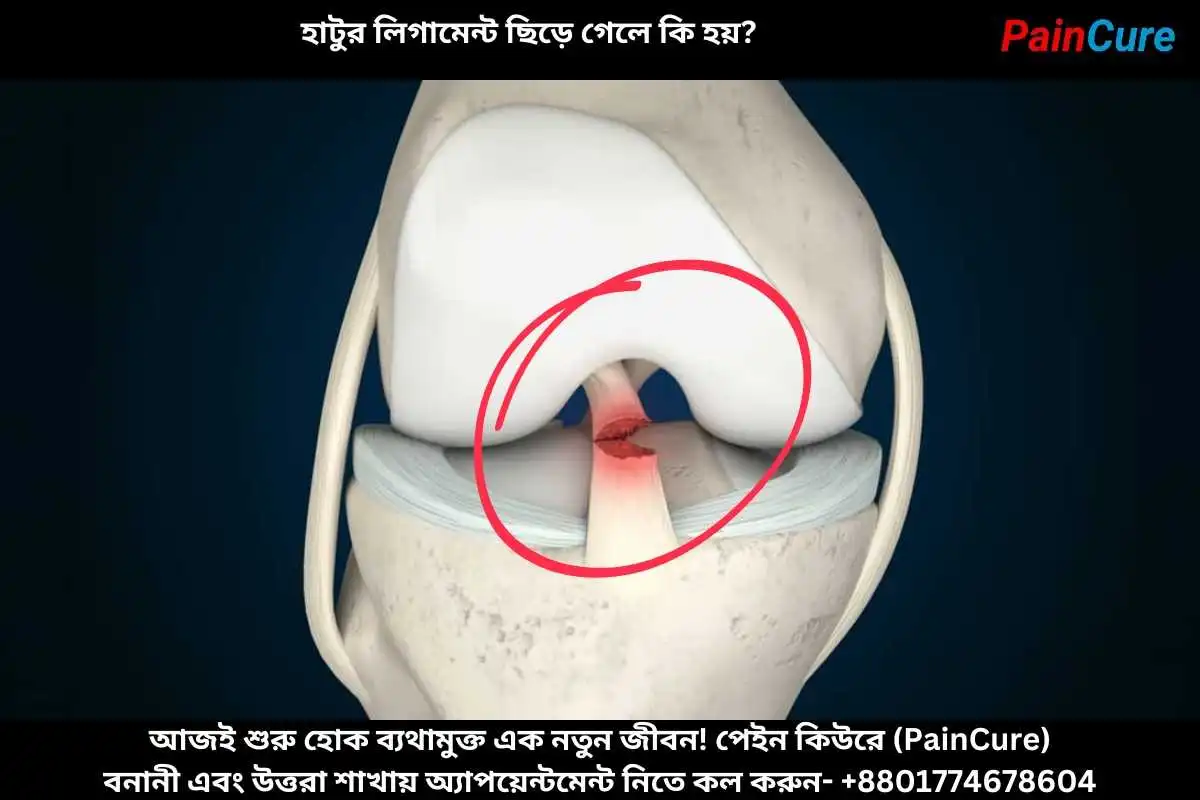 হাটুর লিগামেন্ট ছিড়ে গেলে কি হয়