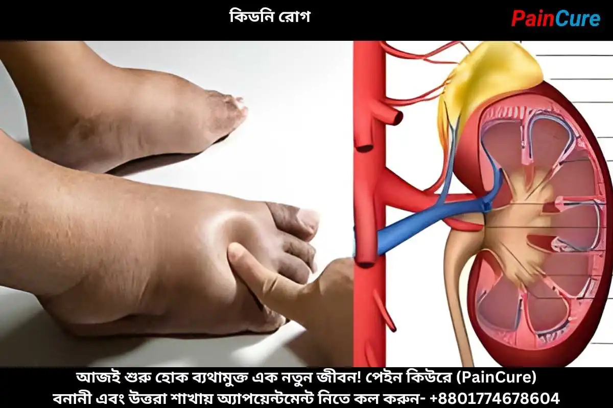 কিডনি রোগ