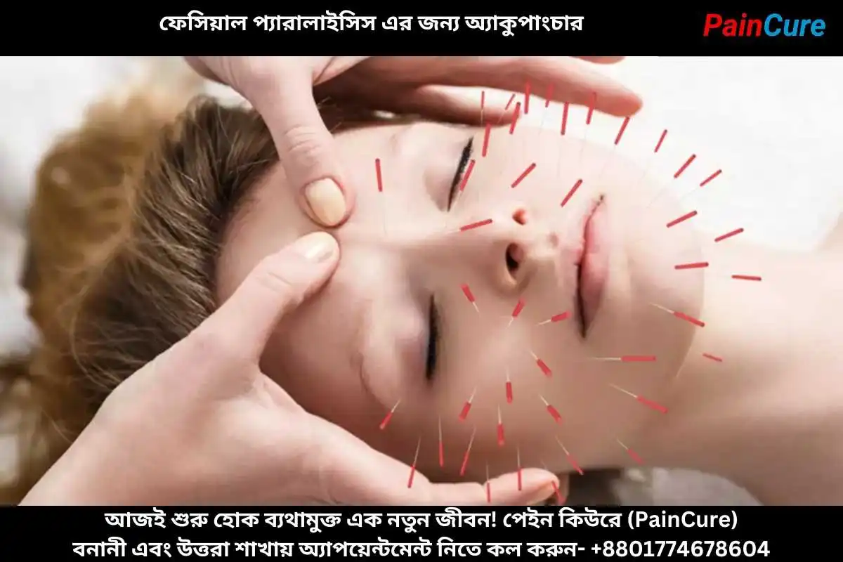 ফেসিয়াল প্যারালাইসিস এর জন্য অ্যাকুপাংচার