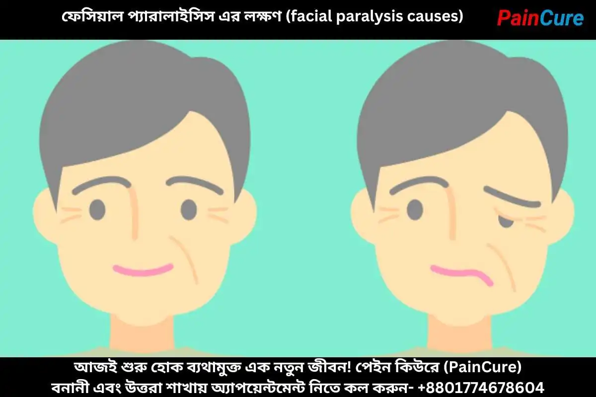 ফেসিয়াল প্যারালাইসিস এর লক্ষণ