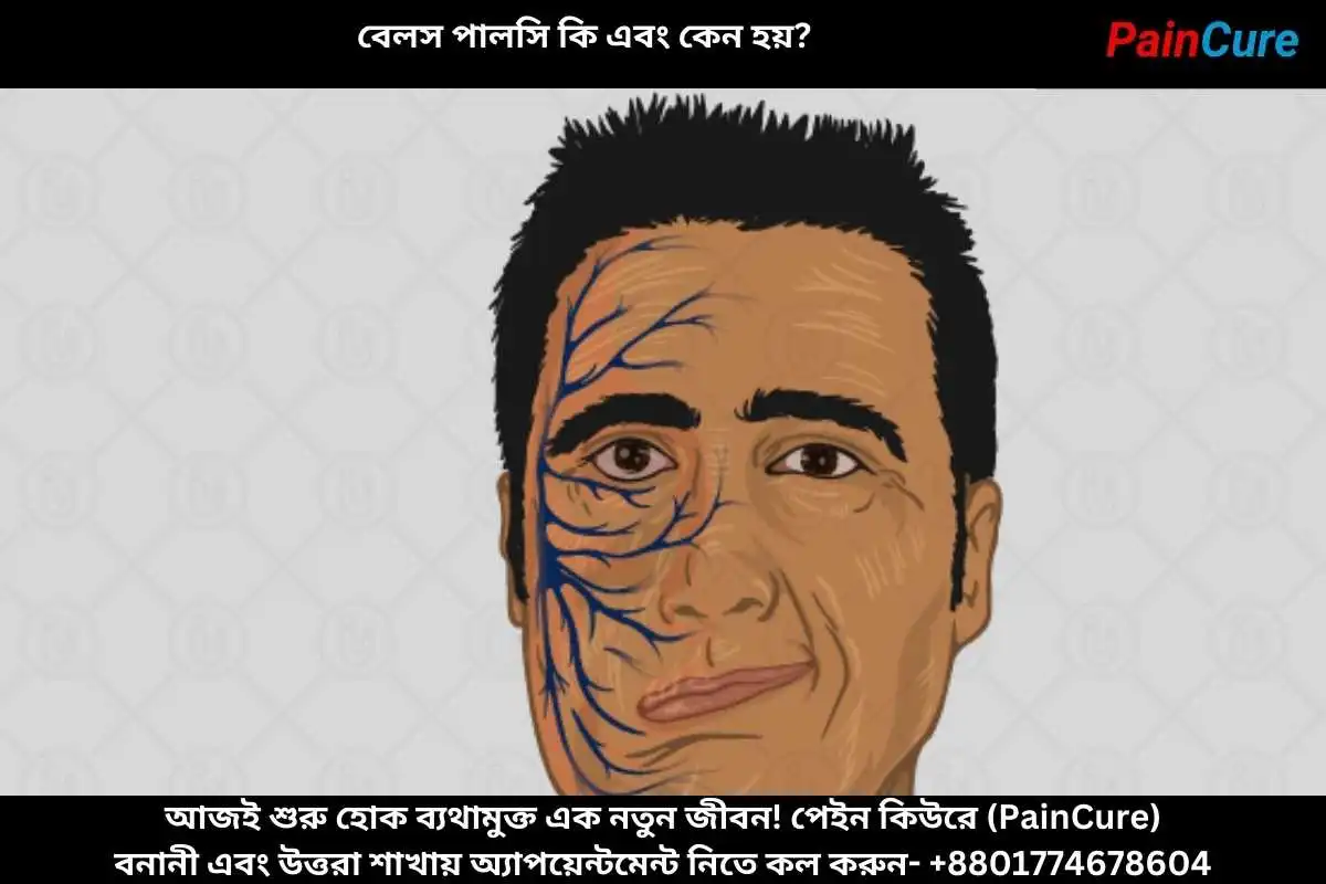 বেলস পালসি কি এবং কেন হয়
