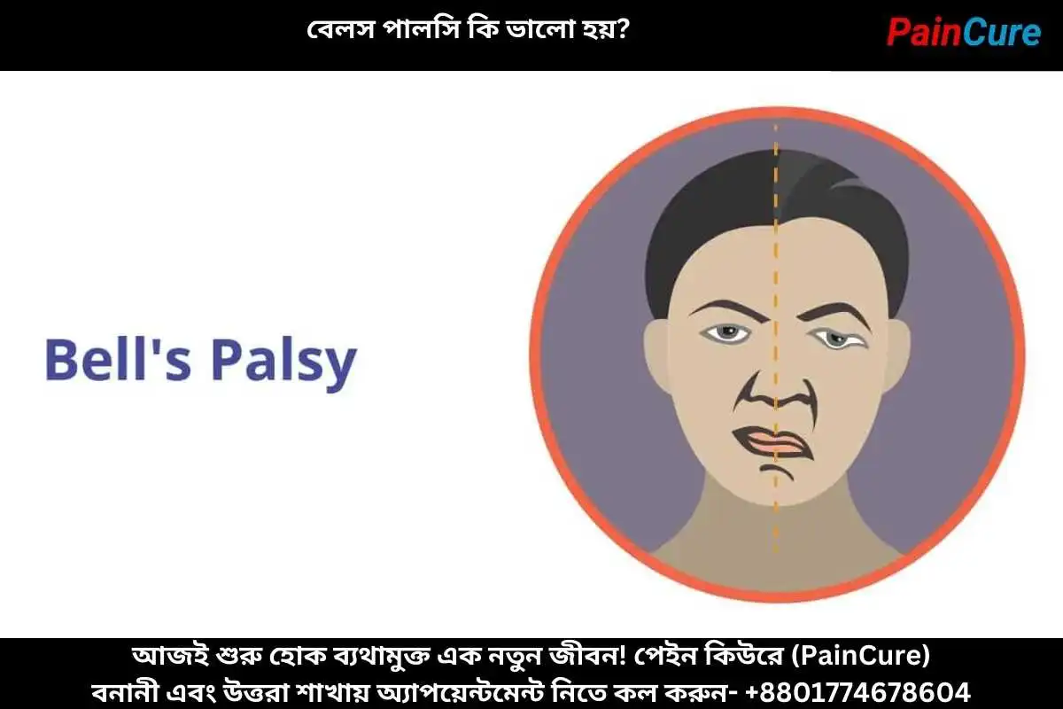 বেলস পালসি কি ভালো হয়