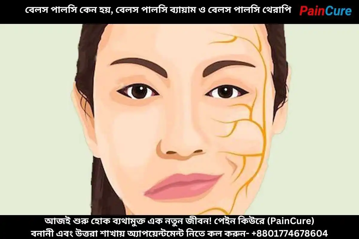 বেলস পালসি কেন হয়, বেলস পালসি ব্যায়াম ও বেলস পালসি থেরাপি