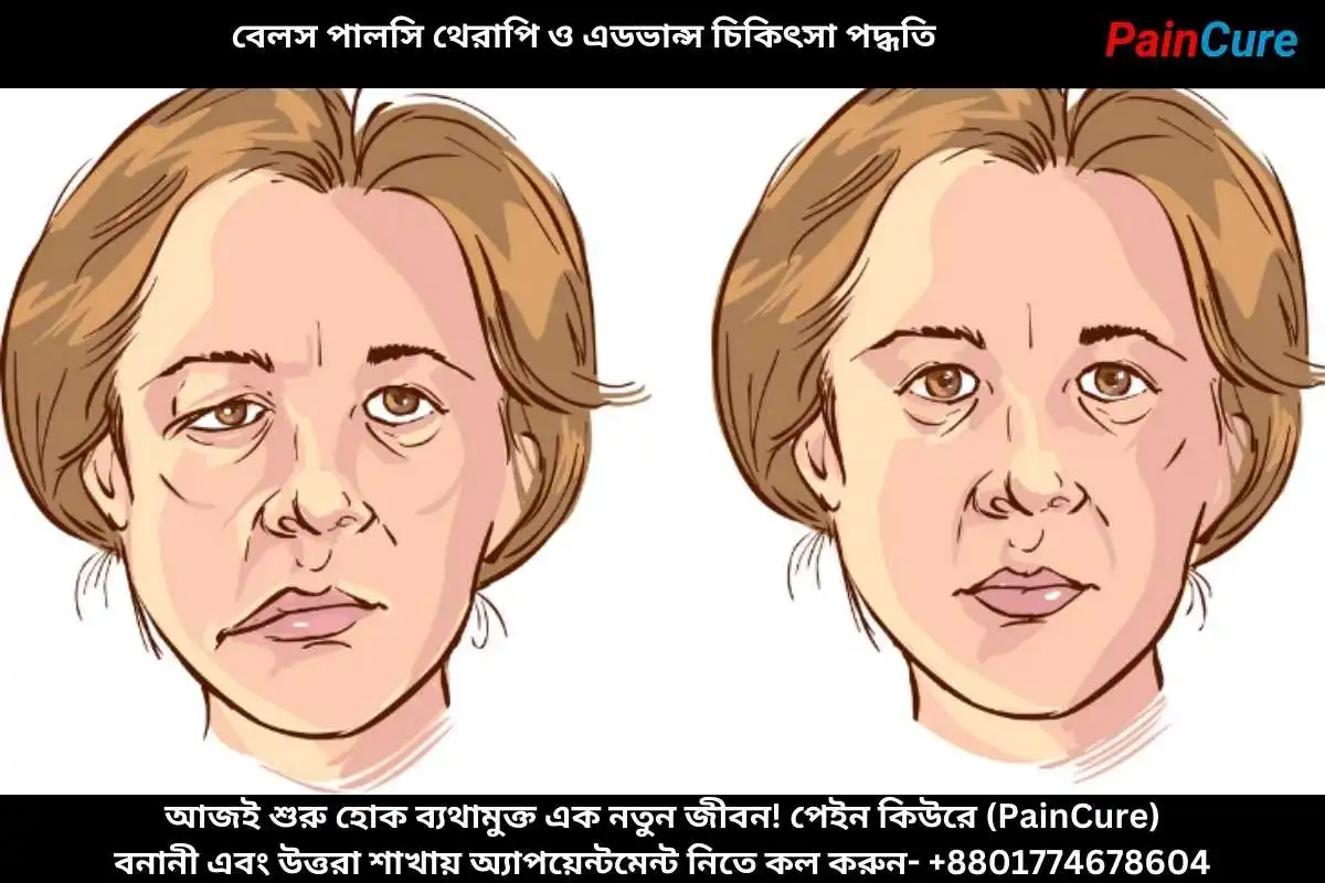 বেলস পালসি থেরাপি ও এডভান্স চিকিৎসা পদ্ধতি