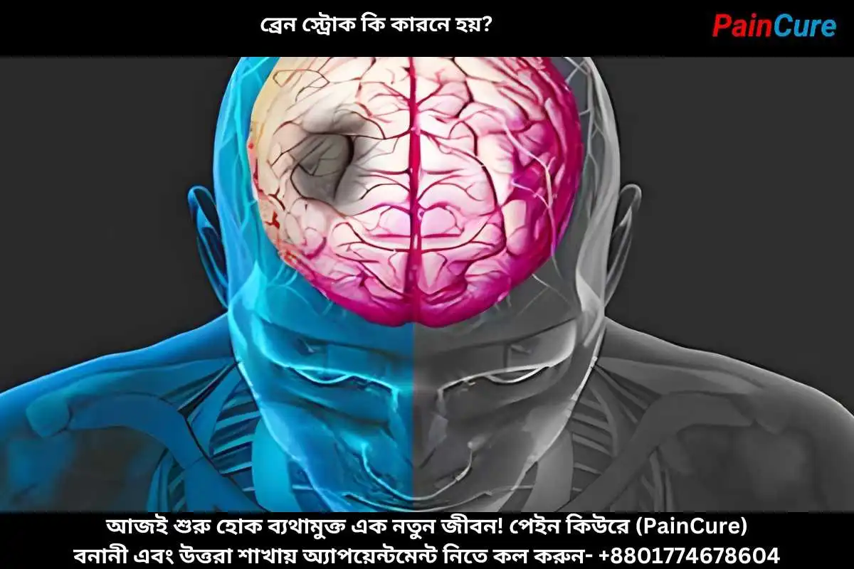 ব্রেন স্ট্রোক কি কারনে হয়