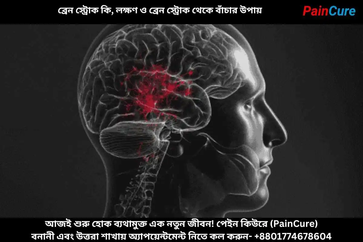 ব্রেন স্ট্রোক কি, লক্ষণ ও ব্রেন স্ট্রোক থেকে বাঁচার উপায়