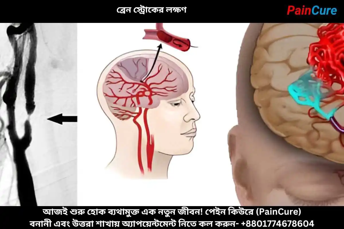 ব্রেন স্ট্রোকের লক্ষণ