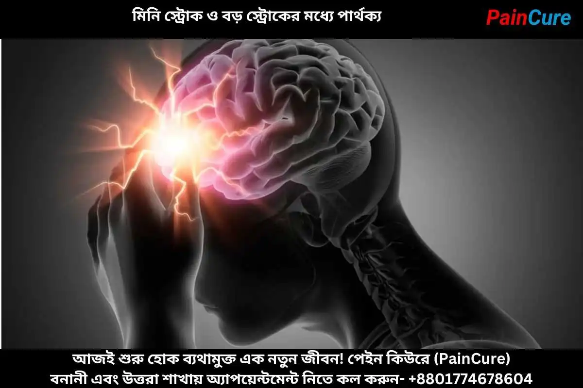 মিনি স্ট্রোক ও বড় স্ট্রোকের মধ্যে পার্থক্য