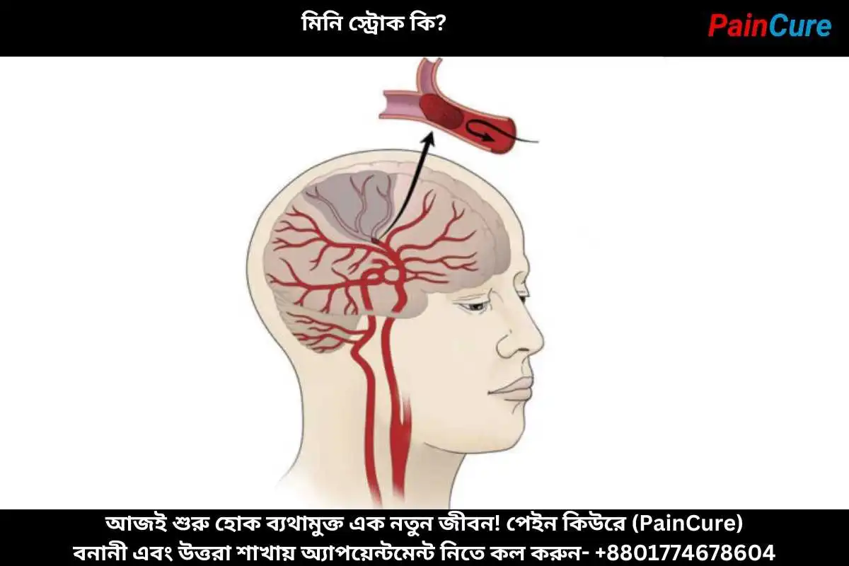 মিনি স্ট্রোক কি