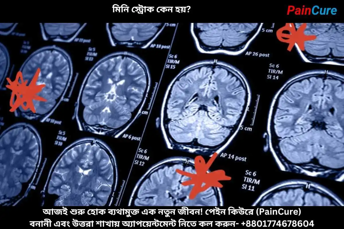 মিনি স্ট্রোক কেন হয়
