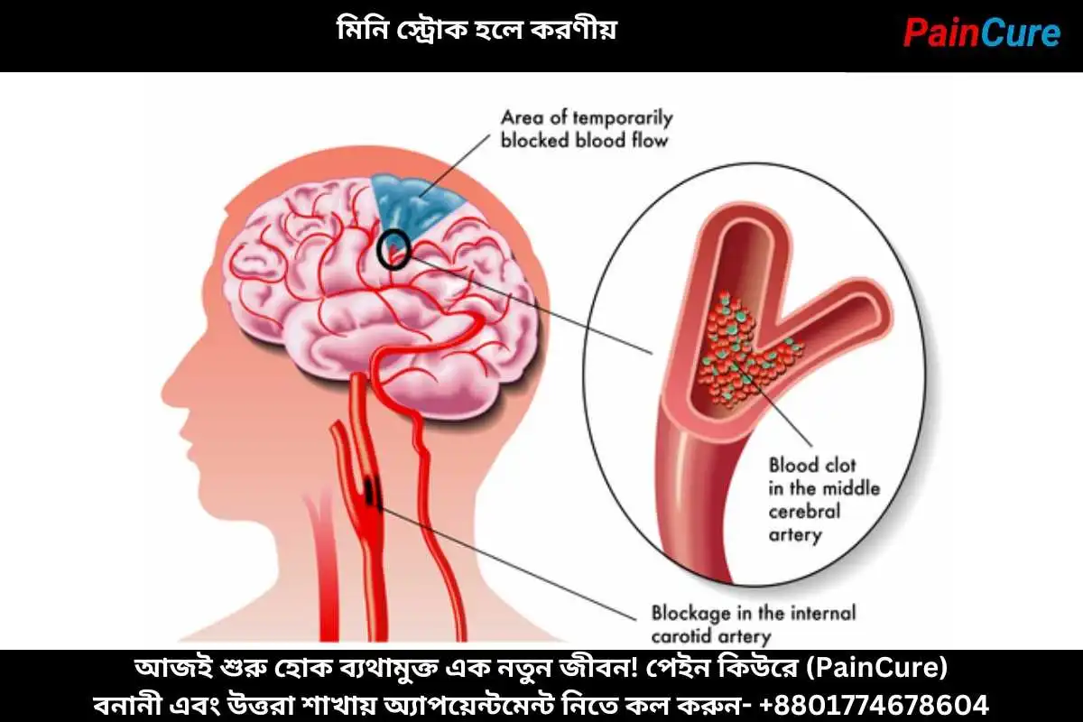 মিনি স্ট্রোক হলে করণীয়