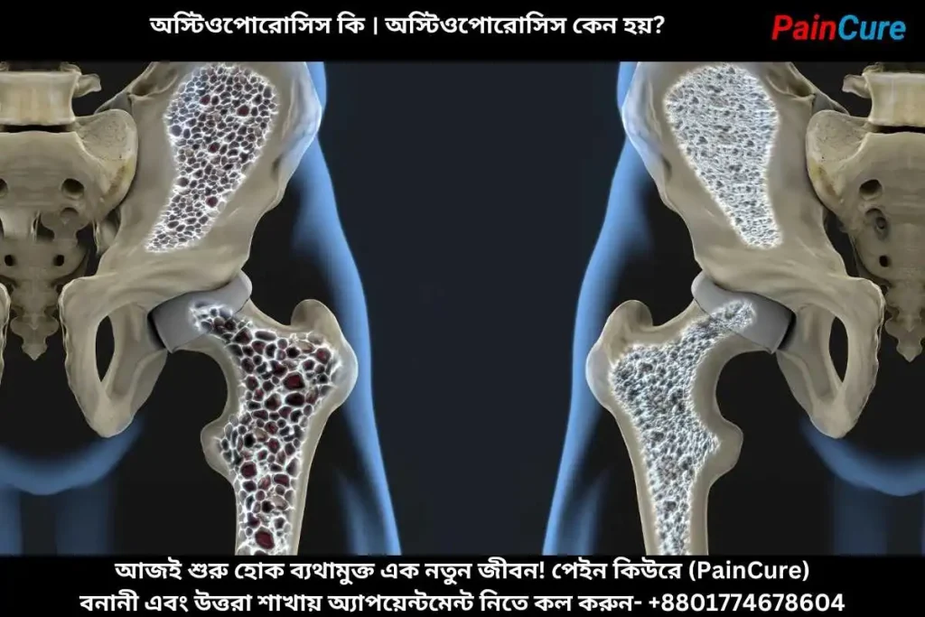 অস্টিওপোরোসিস কি । অস্টিওপোরোসিস কেন হয়?