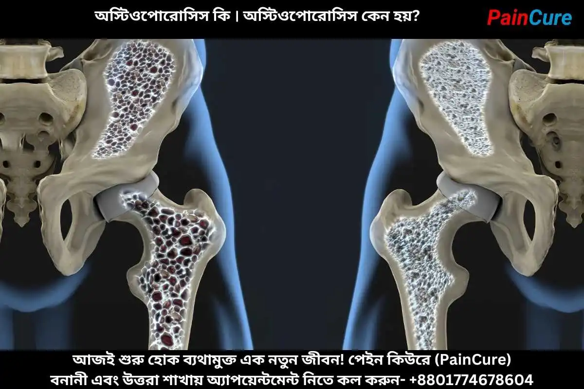 অস্টিওপোরোসিস কি । অস্টিওপোরোসিস কেন হয়?