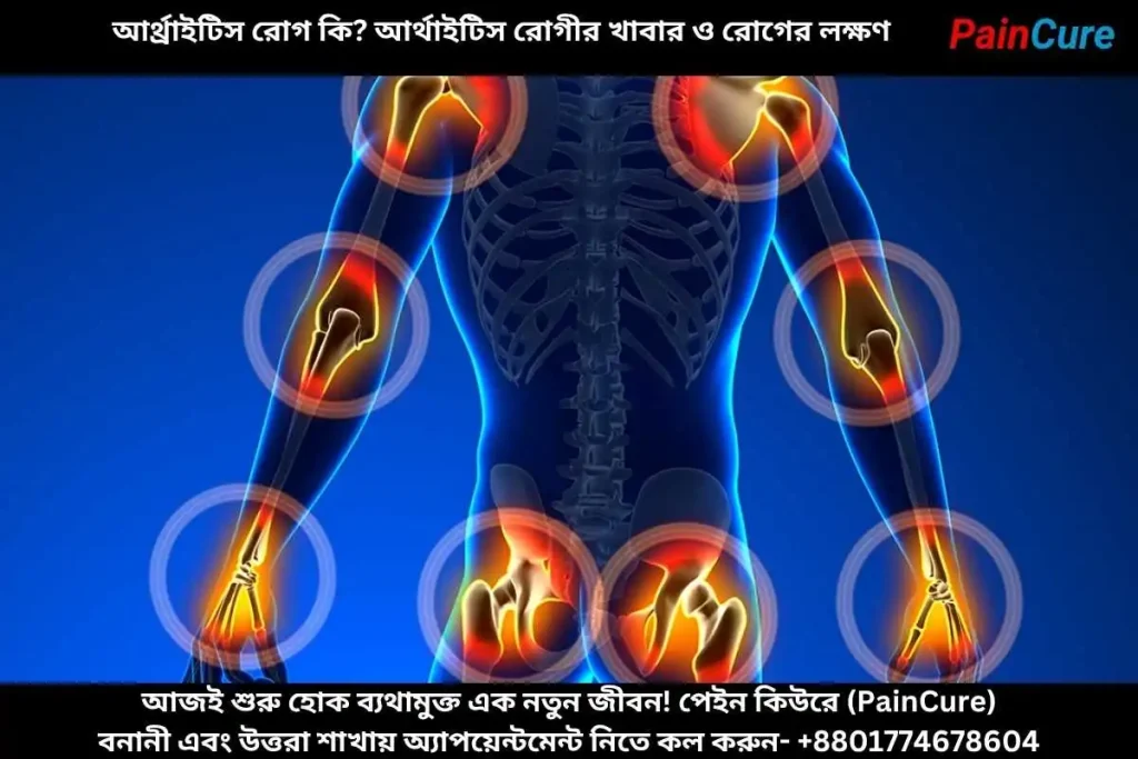 আর্থ্রাইটিস রোগ কি ?আর্থাইটিস রোগীর খাবার ও রোগের লক্ষণ